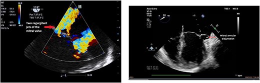 Preoperative echocardiography of patient 1.