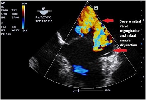 Preoperative echocardiography of patient 2.