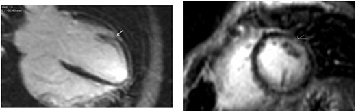 Midwall fibrosis in the mid-anterolateral wall of patient 1.