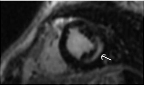 Midwall fibrosis in the mid-anterolateral wall of patient 2.