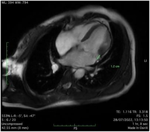 Mitral annular disjunction 12 mm of patient 1.