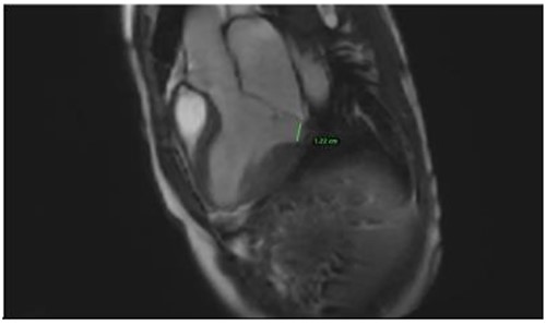 Mitral annular disjunction 12 mm of patient 2.