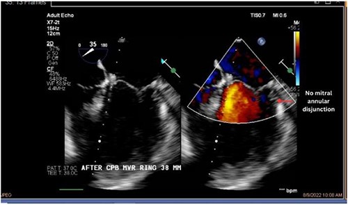 Postoperative echocardiography of patient 1.