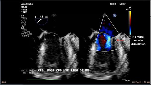 Postoperative echocardiography of patient 2.