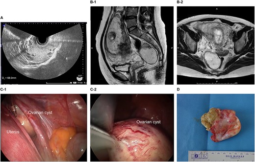 Imaging studies and laparoscopic views and specimen photograph of case 1. (A) Transvaginal ultrasound image showing an ovarian cyst. (B-1) Sagittal T2-weighted magnetic resonance image (MRI) showing an ovarian cyst. (B-2) Axial T2-weighted MRI showing an ovarian cyst. (C-1) Gestational uterus: ovarian cyst was moved from the pouch of Douglas. (C-2) Ovarian cyst was moved and located on the gestational uterus. (D) Ovarian Cyst.