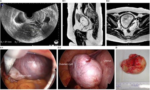 Imaging studies and laparoscopic views and specimen photograph of case 2. (A) Transvaginal ultrasound image showing an ovarian cyst. (B-1) Sagittal T2-weighted magnetic resonance image (MRI) showing an ovarian cyst. (B-2) Axial T2-weighted MRI showing an ovarian cyst. (C-1) Gestational uterus: ovarian cyst was moved from the pouch of Douglas. (C-2) Ovarian cyst was moved and located on the gestational uterus. (D) Ovarian Cyst.