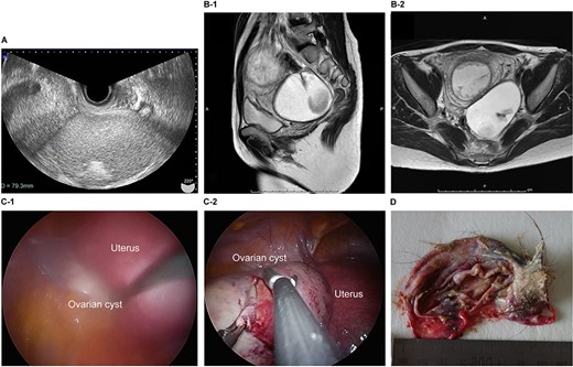 Imaging studies and laparoscopic views and specimen photograph of case 3. (A) Transvaginal ultrasound image showing an ovarian cyst. (B-1) Sagittal T2-weighted MRI showing an ovarian cyst. (B-2) Axial T2-weighted MRI showing an ovarian cyst. (C-1) Gestational uterus: ovarian cyst was moved from the pouch of Douglas. (C-2) Ovarian cyst was moved and located on the gestational uterus. (D) Ovarian Cyst.
