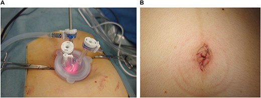 Single-port system and umbilicus wound. (A) Single-port system for laparoscopic viewing: Lap Disc Mini (Hakko Corporation, Osaka, Japan) and EZ Access (Hakko Corporation). (B) Postoperative umbilicus wound.