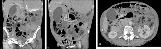 (A–C) Abdominal CT scan with oral and intravenous contrast revealing PI with gastric and proximal small bowel dilatation, without evidence of perforation or ischaemia.