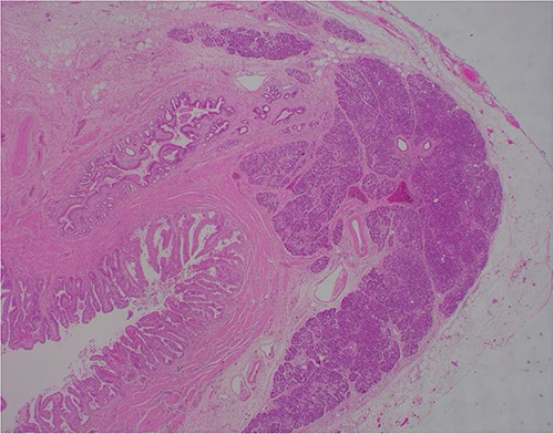 ×2 objective lens; low-magnification photograph showing an area of pancreatic heterotopia.
