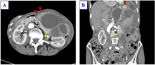 (A) Enhanced CT shows a huge mass lesion with a mixture of cystic and solid parts, occupying the left upper quadrant and flank, and the tumor expansively compressed the stomach ventrally (red arrows). (B) Only a small portion of the normal spleen parenchyma remains (red arrow). The tail of the pancreas is partially in contact with the tumor (yellow arrow), but the border of the pancreas is relatively smooth.