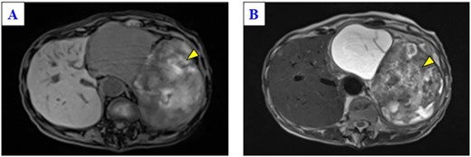 Magnetic resonance imaging of the solid part of the tumor shows a heterogeneous hyperintense area in a T1-weighted image (A) and a hypointensity area in a T2-weighted image (B) (yellow arrows).