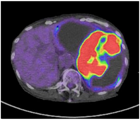 The solid part of the tumor has a higher uptake of 18F-fluorodeoxyglucose (standardized uptake value of 35.9) on positron emission tomography, and no obvious evidence of distant metastasis is present.