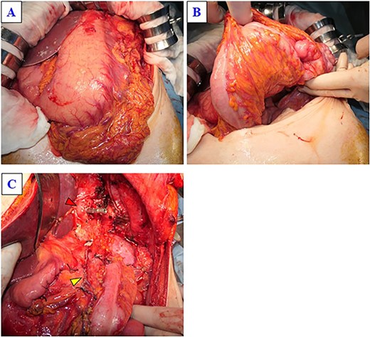 (A) The tumor is located in the posterior wall of the stomach, extending from the body to the gastric cardia, with a diameter of ~25 cm. (B) The tumor has invaded part of the transverse colon. (C) This image was obtained after the specimen was removed. The yellow arrow indicates the stump of the pancreas, and the red arrow indicates the stump of the esophagus.