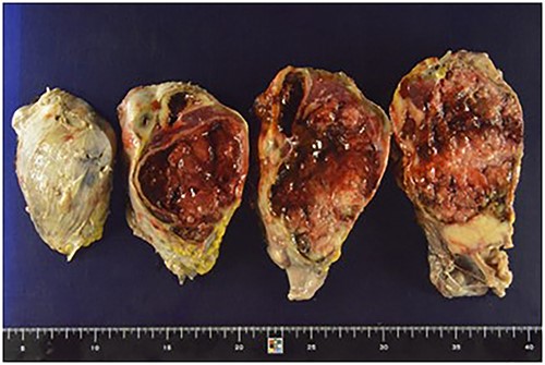 The resected specimen, 24 × 15 cm, was a solid yellowish tumor with a fibrous capsule and central necrotic change, growing inside the spleen, and also partly touching the pancreatic tail.
