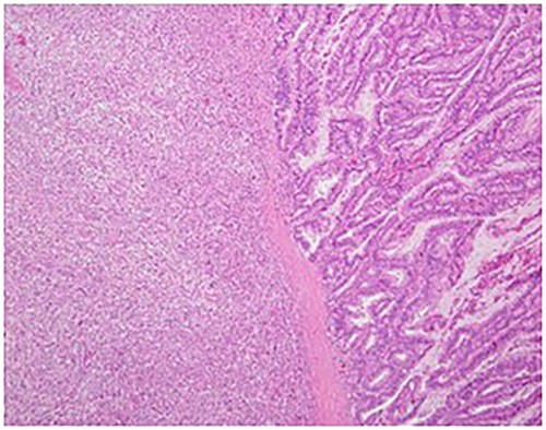 Hematoxylin–eosin staining showed spindle cells and multinuclear giant cells, which are characteristic of anaplastic carcinoma of the pancreas (original magnification: ×30).