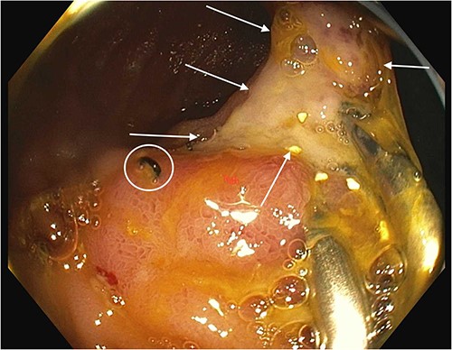 Anastomotic ulcer prior to OTSC use. Arrows show anastomotic ulcer. Circle shows surgical staple at anastomosis. Hemostatic clips that were previously applied to attempt hemostasis are present on the right side of the ulcer.