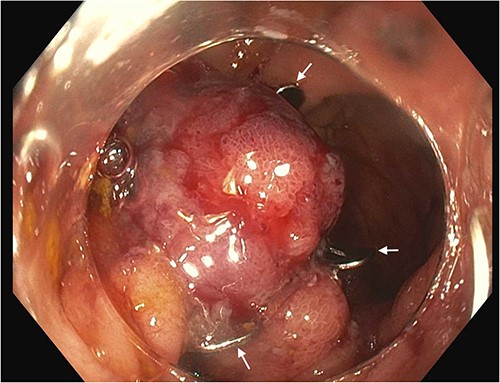 Anastomotic ulcer following OTSC use. Arrows show edges of the OTSC that was deployed on the ulcer. Approximated margins of the ulcer are visible within the clip.