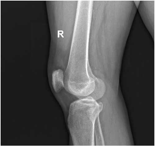 Lateral X-ray of the right knee without findings of patella baja and osseous pathology.