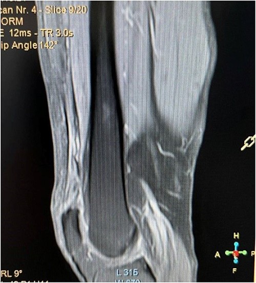 Fat saturated proton density sagittal view showing the rupture of the vastus IT with an intact rectus femoris tendon.