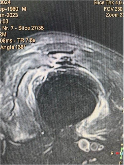 Fat saturated T2 axial view showing the rupture of vastus intermedius and vastus medialis tendon.