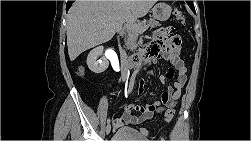 CT scan reconstruction with the image of the S-shaped ureter behind the IVC.