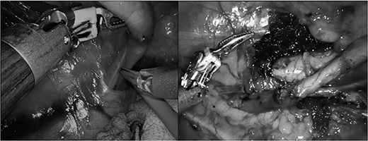 Intraoperative images of the ureter behind the IVC and after the transposition and the ureteroureterostomy.