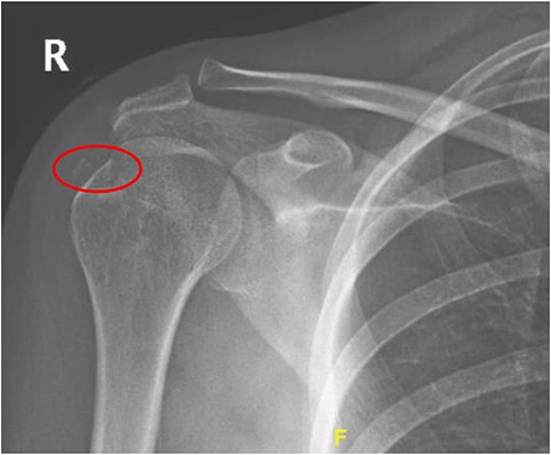 Radiograph of right shoulder showing calcification around the insertion of supraspinatus tendon.