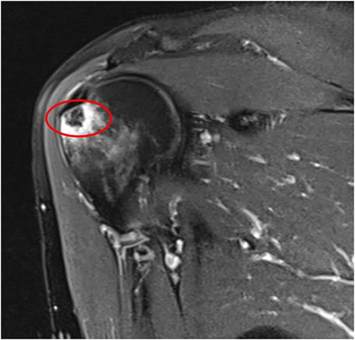 Coronal T2 image of right shoulder showing hypointense lesion; note: the red circle indicates the intraosseous extension of calcified deposits originating from calcified supraspinatus tendon, with surrounding marrow edema.