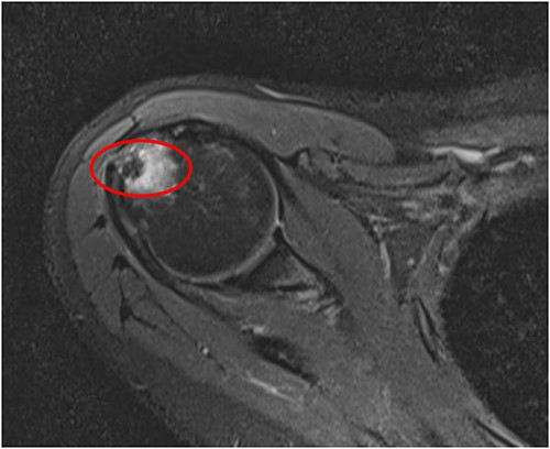 Axial T2 image of right shoulder showing hypointense lesion; note: the red circle indicates the intraosseous extension of calcified deposits originating from calcified supraspinatus tendon, with surrounding marrow edema.