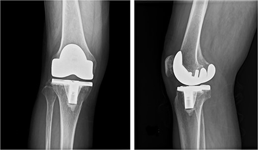 Preoperative anteroposterior and lateral radiographs of the knee show no evidence of aseptic loosening.