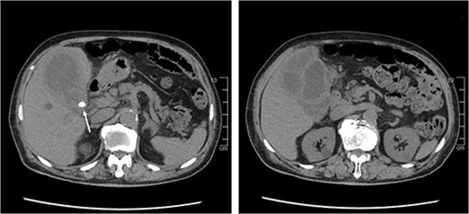 CT scan of the abdomen shows diffuse thickening of the gallbladder wall and gallstones lodged in the bile duct (white arrow).