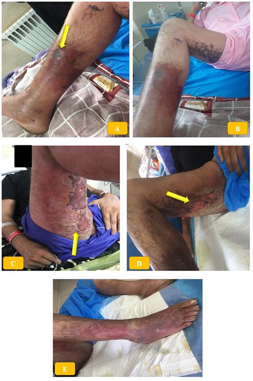 (A, B) Necrotic skin wound on the medial aspect of the right lower third of the leg, associated with erythema, swelling and warmth extended to the dorsum of the foot. (C–E) Diffuse bruises and blisters in posterior thigh and buttock region.