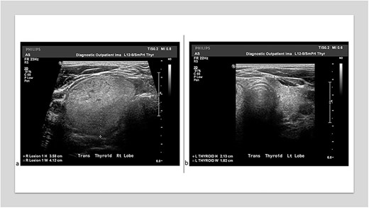 (a) Thyroid ultrasound showed an isoechoic 3.58 × 4.12 cm3 nodule in the right lobe. (b) A thyroid ultrasound showed a left lobe 2.13 × 1.82 cm3.