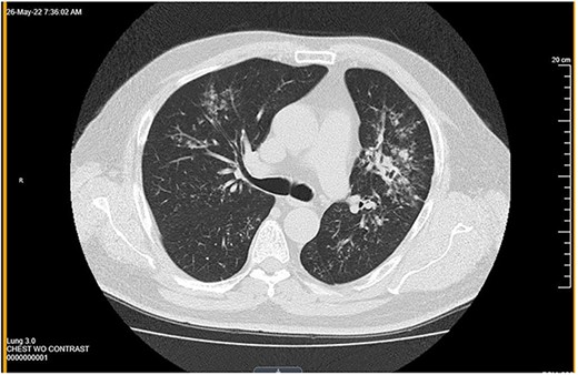 Computed tomography showed multiple nodules in the left pulmonary parenchyma.