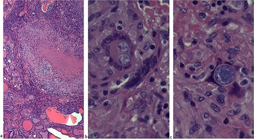 (a) The thyroid lobe consisted of caseating and noncaseating granulomas. (b) Thyroid lobe with spherules (10–40 μm). (c) C. immitis.