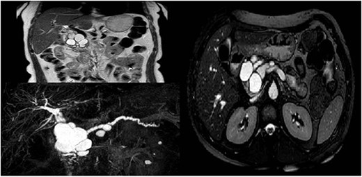 Radiological features of a large complex cyst of the pancreatic head.