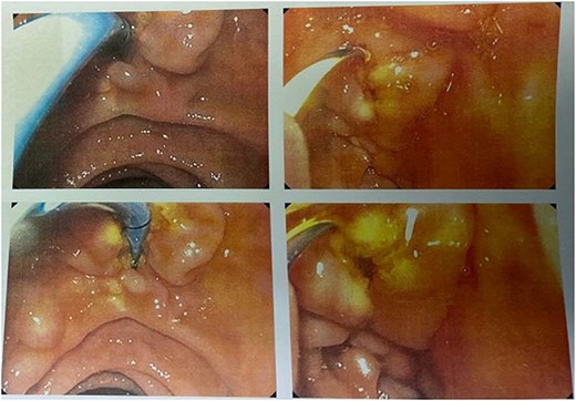 Endoscopic features of an IPMN-like lesion.