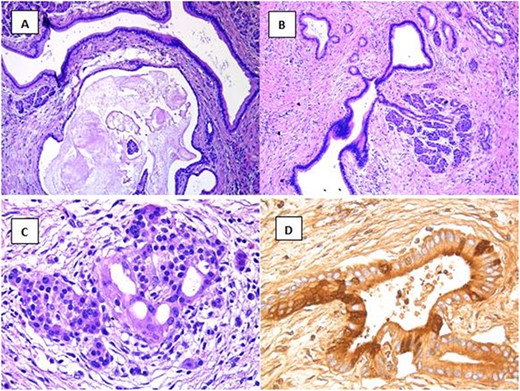 Multiple cists of variable sizes containing amorphous material (A, H&E ×10) and connected to acini (B, H&E ×10); Islet of Langerhans with microcystic dilation (C, H&E ×20); positive immunohistochemical stain for trypsin (D).