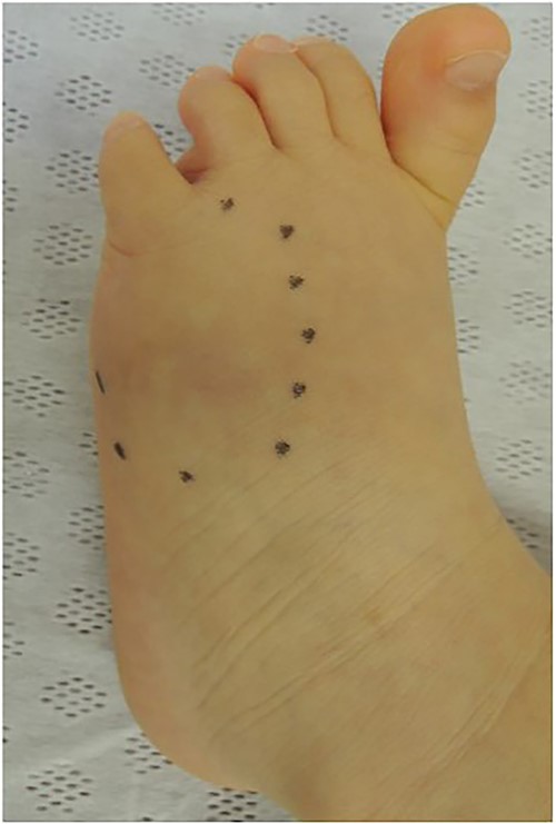 The mass, ~3 × 3 cm, was located on the dorsolateral aspect of the left foot and was hard accompanied by local heat.