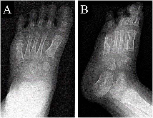 Plain radiographs of the left foot showing a lytic lesion without periosteal reaction in the fifth metatarsal bone in (A) anteroposterior and (B) oblique views.