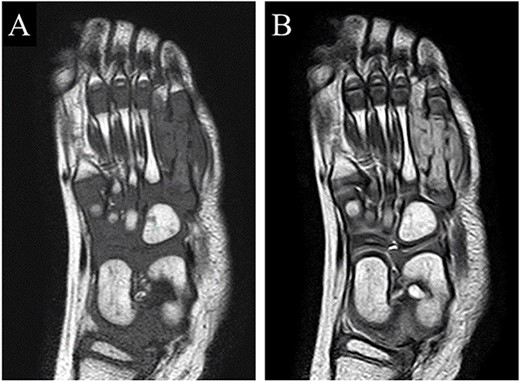 MRI showed an isointense lesion on T1-weighted images and a hyperintense lesion on T2-weighted images around and within the fifth metatarsal.