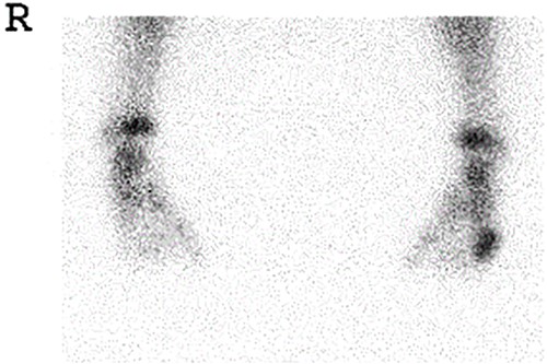 Gallium scintigraphy revealed intense uptake in the patient’s left foot.