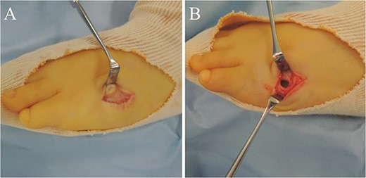 (A) The lesion was yellow and consisted of weak, adipose-like tissue that surrounded and continued into the inferior of the fifth metatarsal bone; (B) The lesion inside and outside the bone was resected as much as possible.