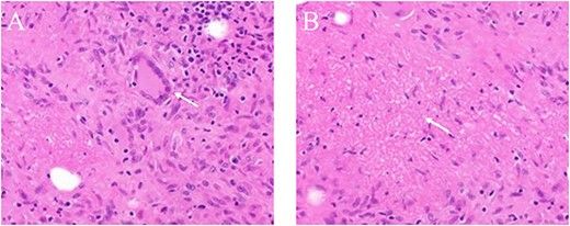 The histopathologic examination of the lesion showed granulomatous inflammation including anaplastic giant cells; (A) Langerhans-type giant cells (white arrow) and (B) Caseous necrosis (white arrow).