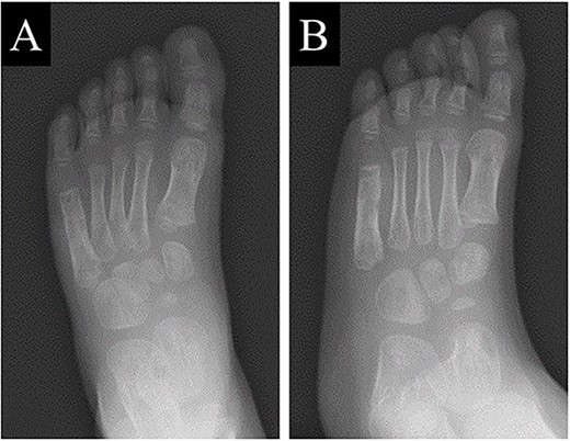 Plain radiographs of the left foot showed the lytic lesion of the fifth metatarsal was remodeled gradually in (A) anteroposterior and (B) oblique views.