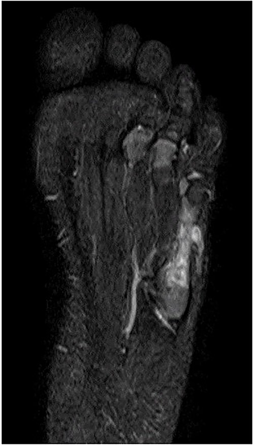 MRI revealed that a high-intensity lesion remained around and inside the fifth metatarsal on T2-weighted fat-suppressed images.