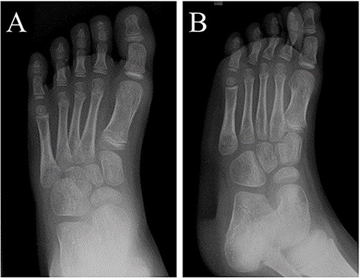 At 6 months after the second surgery, image findings on plain radiographs completely improved on (A) anteroposterior and (B) oblique views.