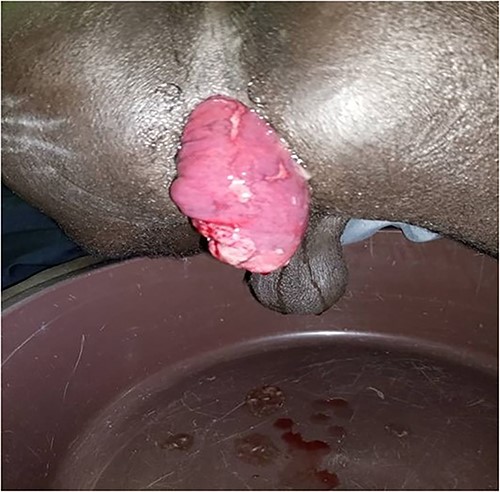 Preoperative image: preoperative photograph of full-thickness rectal prolapse with area of ulceration.