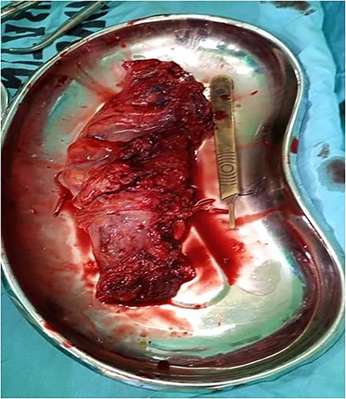 Gross specimen: ~15-cm surgical specimen.